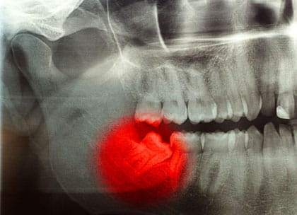 X-ray of painful wisdom tooth